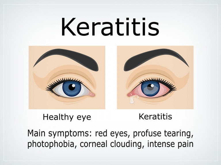 Why You Need to Take Your Contacts Off Before Going to Bed Downtown Eyes