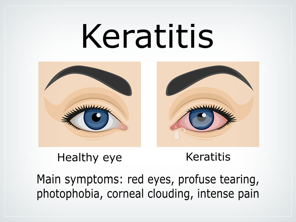 Is lens bad for eyes?